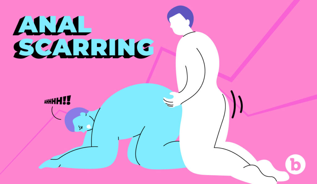 Find out what causes anal scarring and how to manage pain if you plan on having anal sex after surgery